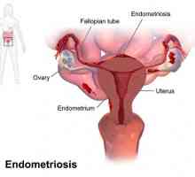Spiralna „Mirena” Endometrioza: recenzije