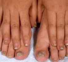 Sredstva iz noktiju gljiva na nogama: prevenciju i liječenje
