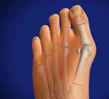 Stupanj deformacije stopala i metode liječenja ove patologije