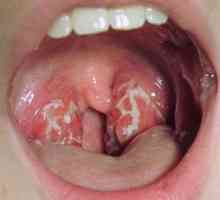 Streptokoke u grlu: simptomi, uzroci i liječenje