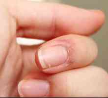 Ispucala koža na prstima oko noktiju: uzroci i liječenje. Ispucala koža na prstima