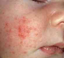 Beba topline osip ili alergije? Kako razlikovati.