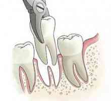 Uklanjanje zuba korijen - složeni, ali najviše bezbolan postupak