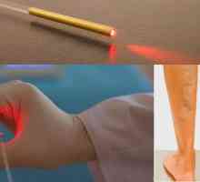 Vene laser za uklanjanje: mišljenja, posljedice i rehabilitacija