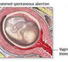 Prijetio pobačaj: uzroci, simptomi i karakteristike liječenja