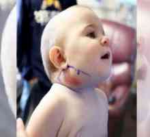 Povećani limfni čvor na djetetovom vratu. Uzroci i liječenje
