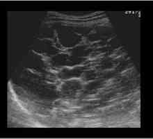 Ultrazvuk jetre: pravilo prijepis. Dimenzije jetre: normalna odrasla osoba