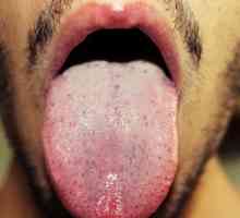Saznajte što je uzrok bijele mrlje na jeziku u odraslih