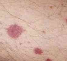 Vaskulitis - lezija od krvnih žila