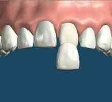 Furnira na prednosti zubi elementu, značajke njegove instalacije i indikacije za upotrebu