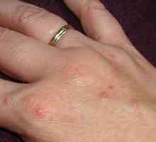 Vodenaste mjehurići na prstima: simptomi i liječenje