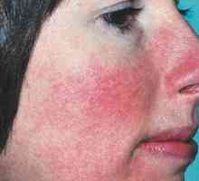 Upala kože na licu: uzroci, vrste, prevenciju i liječenje značajke
