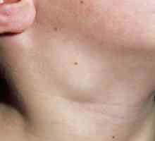 Povećani limfni čvorovi na vratu djeteta: uzroci i liječenje