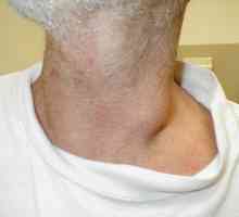 Upaljeni limfni čvor na vratu, što učiniti na prvom mjestu?