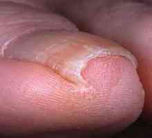 Ingrowing liječenje i prevencija noktiju