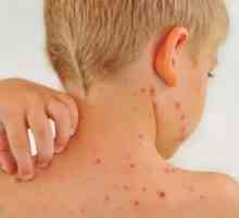 Osip na koži u obliku crvenih točkica: Uzroci