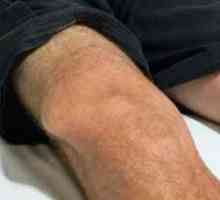 Dislociranost zgloba koljena: glavni simptomi, liječenje