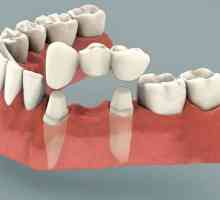 Zubni most: recenzije. Instaliranje zubni most