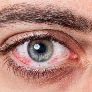 Alergija na oči: kako se postupa, učinkovite metode i preporuke