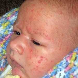 Alergija na dijete nije razlog za očaj