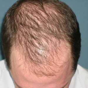 Ampule gubitka kose - što su i kako se prijaviti