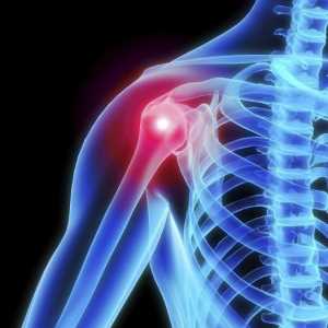 Osteoartritis od ramenog zgloba: Simptomi i liječenje narodnih lijekova, uzroci i metode dijagnoze