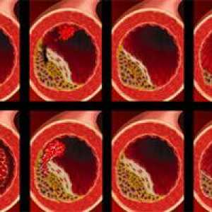Arterioskleroza - simptomi, uzroci i liječenje