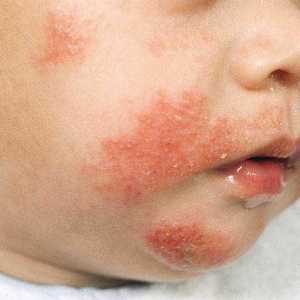 Atopijski dermatitis u liječenju i simptomima djeteta
