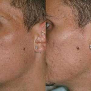 Bezbolan i učinkovit lasersko uklanjanje ožiljaka