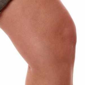 Ono što karakterizira liječenje sinovitis koljena?