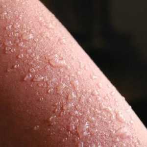 Što uzrokuje osip na koži u obliku mjehurića?