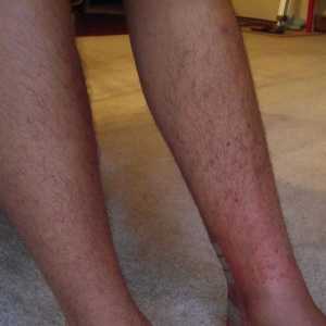 Svrbež osip na nogama: uzroci, prevencija