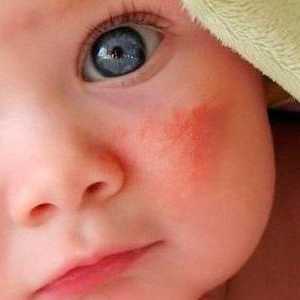 Što učiniti ako dijete ima grube mrlje na tijelu? Što bi to moglo biti