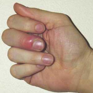 Što možete učiniti ako naiđete prst blizu noktiju