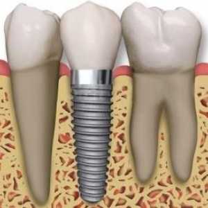 To stomatolozi preporučuju, kada postoji potreba za umetanje zube?