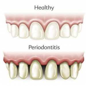 Što je parodontitis? Klasifikacija i liječenje