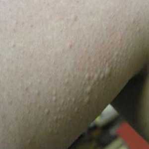 Prištići na rukama: tretman zimskih alergija