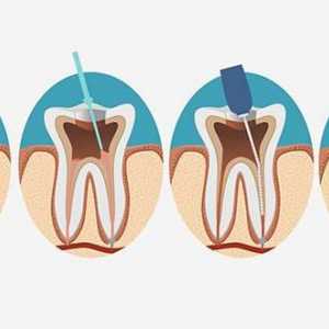 Zub korijenskog kanala: ima tretmani, indikacije