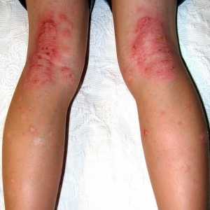 Dermatitis na nogama: uzroci i liječenje