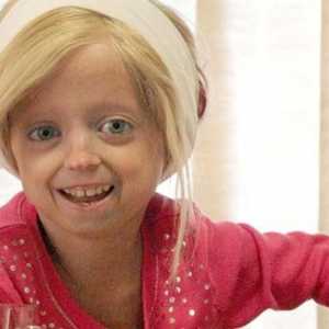 Djeca progerija: Imate li djeci priliku?