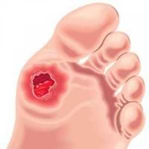 Dijabetička Foot: Simptomi i klasifikacija