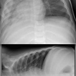 Bilateralna pneumonija: kako se on manifestira, gdje i kako ga liječiti