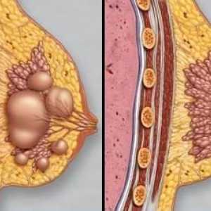 Dojke fibroza: dijagnoza i liječenje