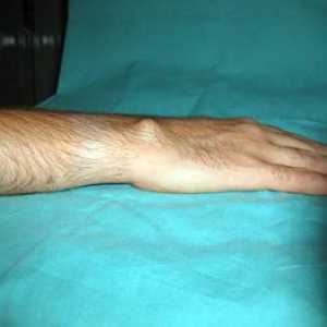 Hygroma zglob: liječenje bez operacije narodnih lijekova (recenzija)