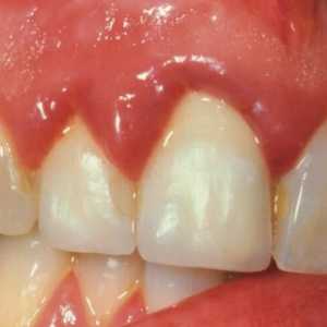 Gingivitis podataka: ispirati grlo na upale zubnog mesa?