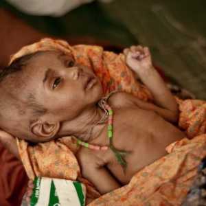 Pothranjenost u djece i njihovih simptoma