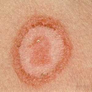 Gljivične bolesti kože je lakše spriječiti nego liječiti