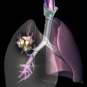 Kemoterapija raka pluća. Kako liječiti rak pluća