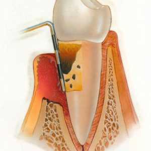 Kronično i akutno parodontitis: simptomi, uzroci i liječenje