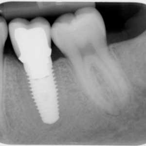 Zubni implantati: kontraindikacije i moguće komplikacije (mišljenja)